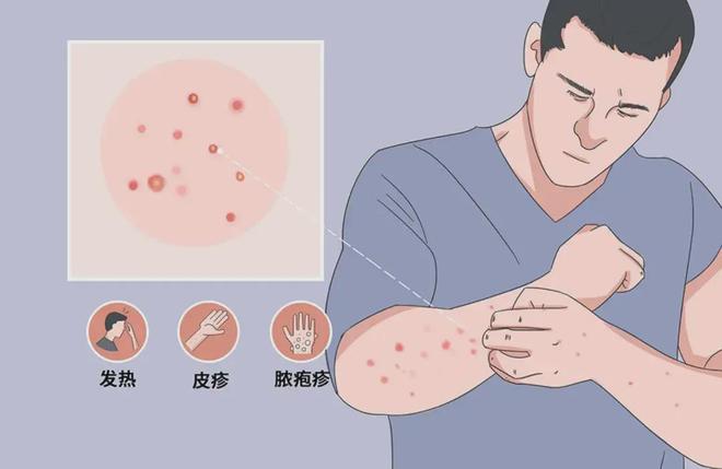 猴痘，了解、预防与应对策略