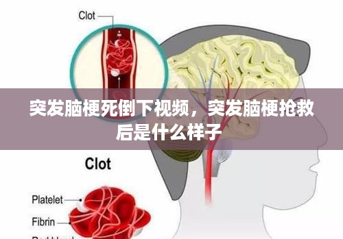 突发脑梗死倒下视频，突发脑梗抢救后是什么样子 