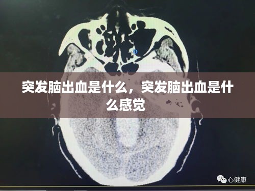 突发脑出血是什么，突发脑出血是什么感觉 