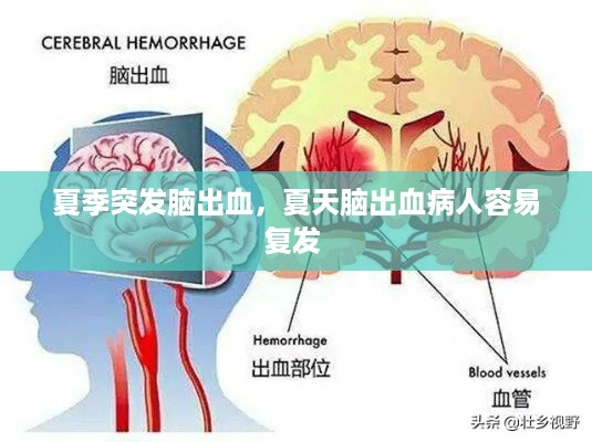 夏季突发脑出血，夏天脑出血病人容易复发 